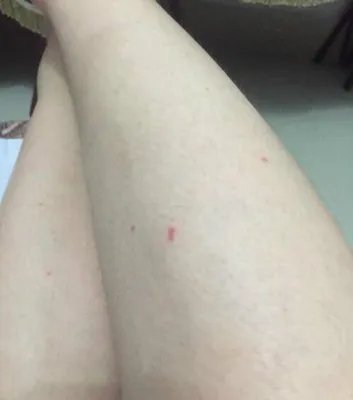 酒店床上十几只臭虫 在身上爬来爬去又叮又咬