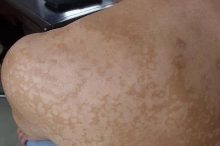 汗斑图片和症状图片