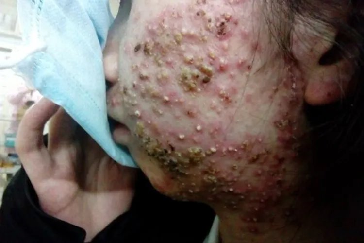 痤疮是什么图片