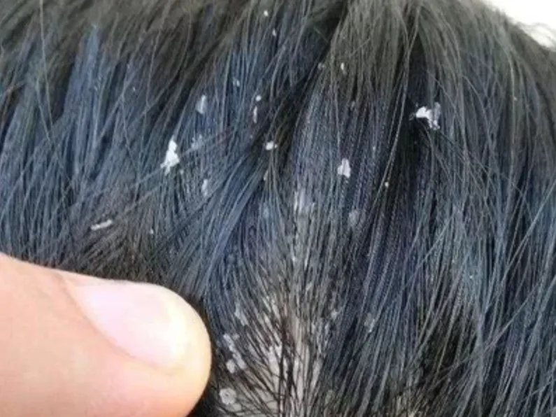 大块头皮屑图片