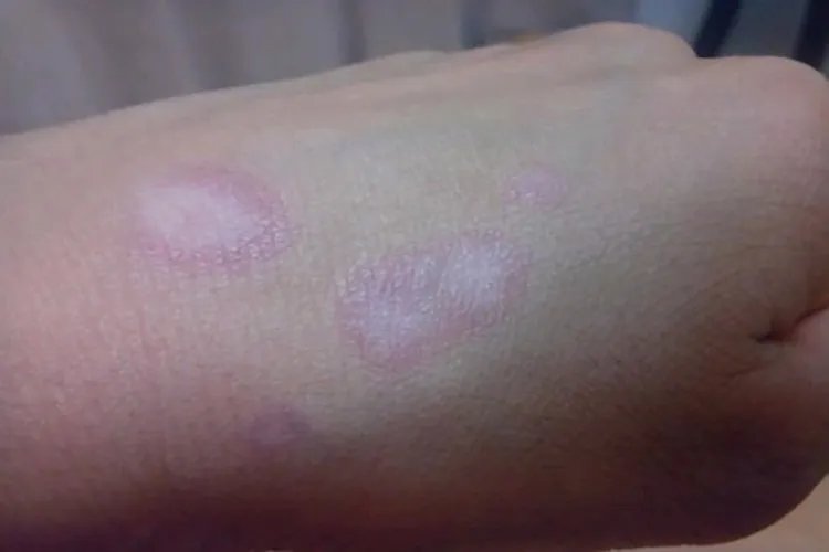 早期白斑症状图片