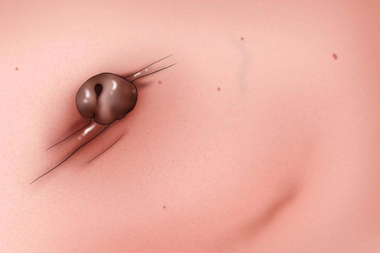 乳腺癌外观图片大全