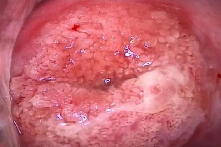 女性宫颈糜烂三度图片