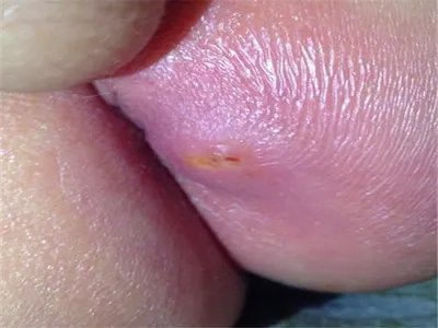 肛门脓肿肛周包块图片