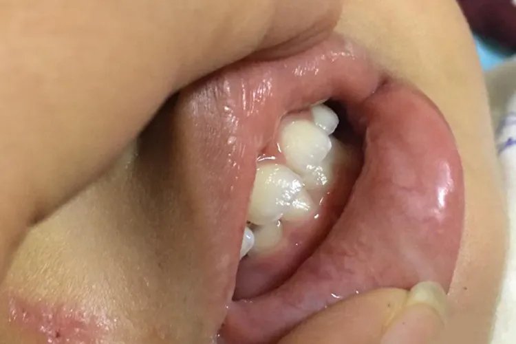 宝宝严重乳牙龅牙图片
