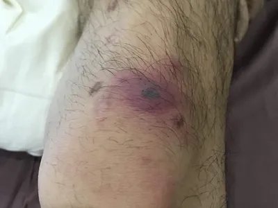 恙虫病焦痂图片