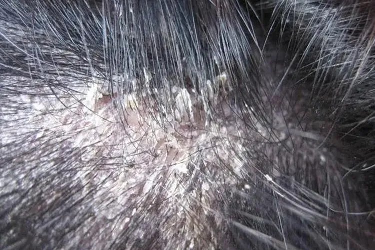 大块头皮屑图片