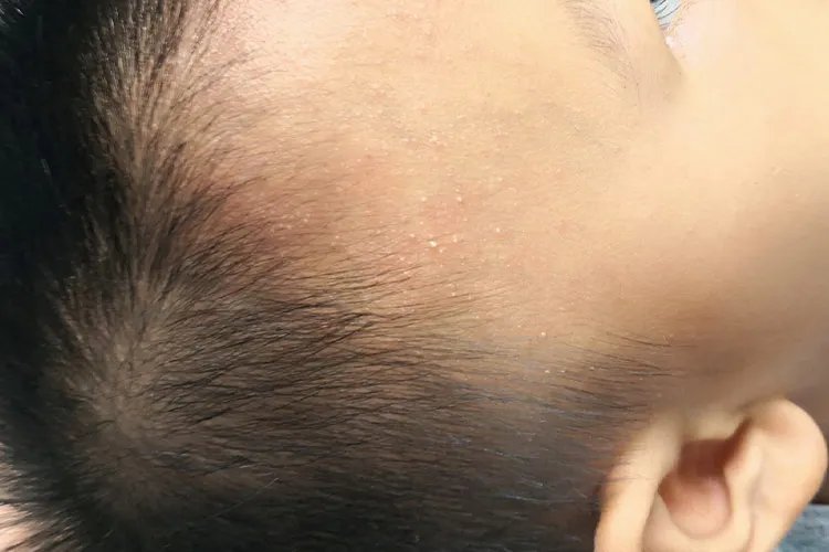 热痱子是什么样图片