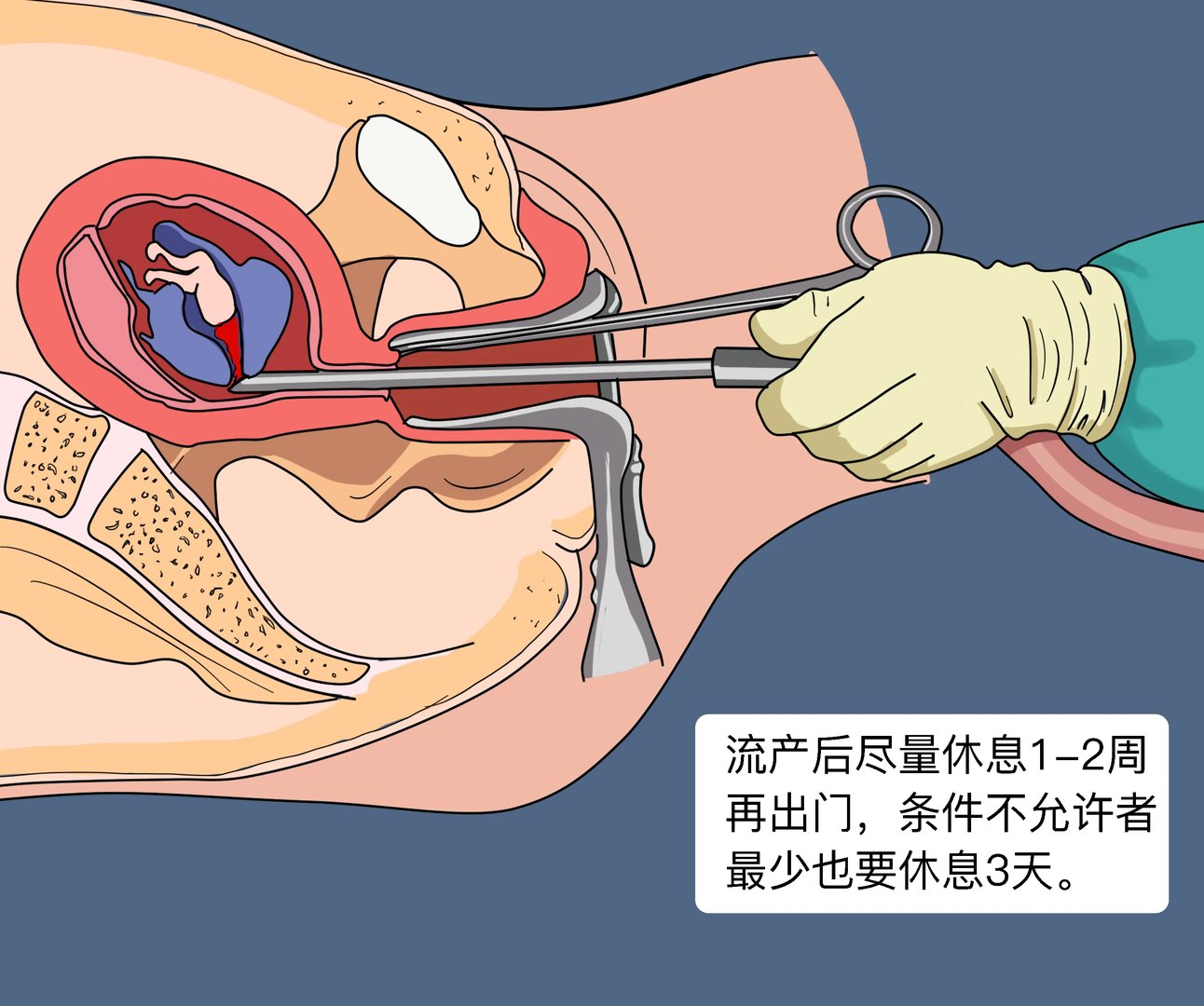 做完流产几天可以出门