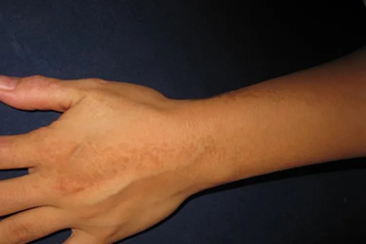 表皮痣手背症状图片