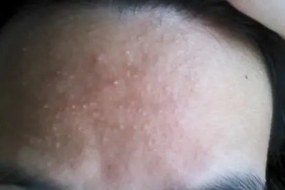 额头上长满了密密麻麻的丘疹图片