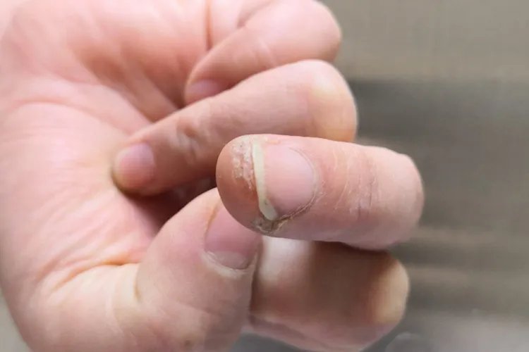 什么是寻常疣图片大全