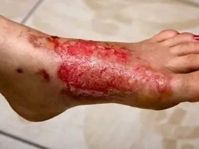 急性网状淋巴管炎脚背症状图片