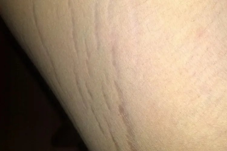 青少年肥胖纹图片