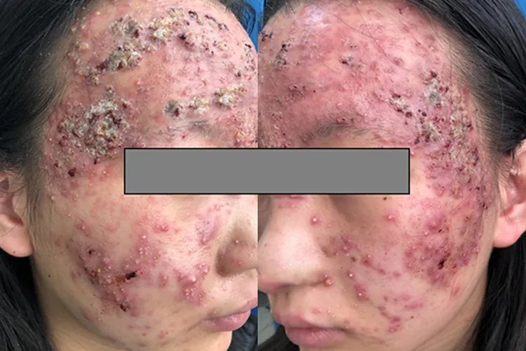 闭口痘痘长什么样子