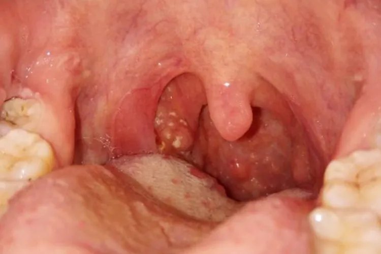 鹅口疮图片