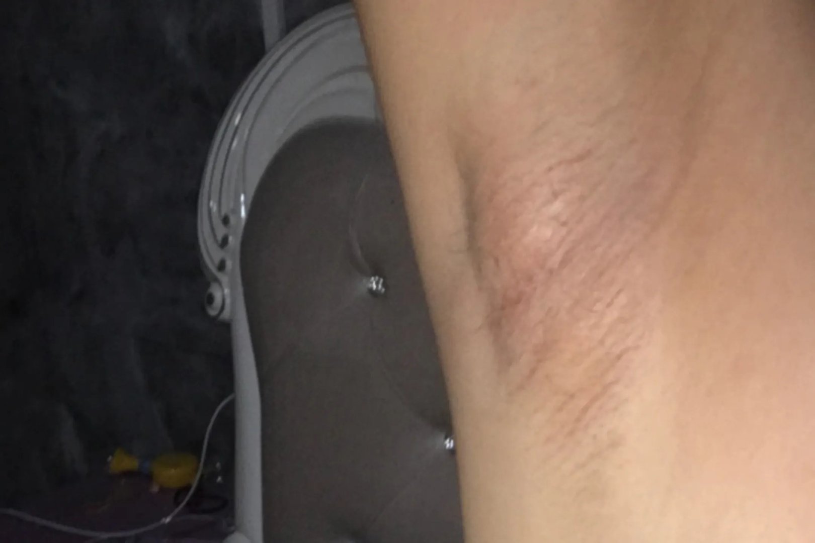 女性腋下淋巴结肿大图