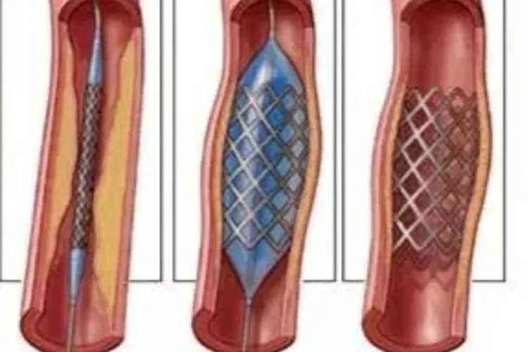 颈动脉支架图片