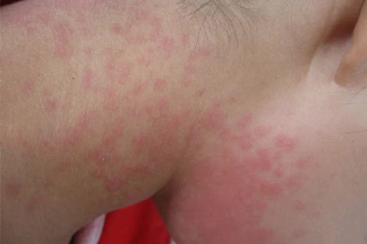 小孩被螨虫咬的症状图片