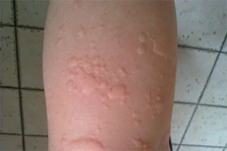 荨麻疹初期症状图片轻微