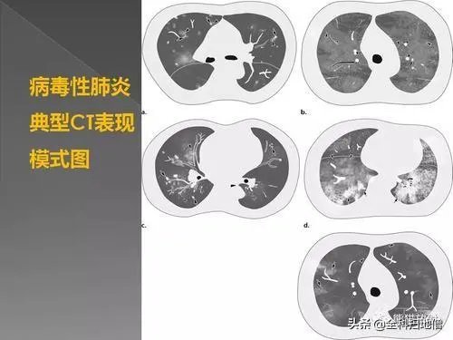 为什么湖北新增病例突增14840例？临床诊断病例是什么？