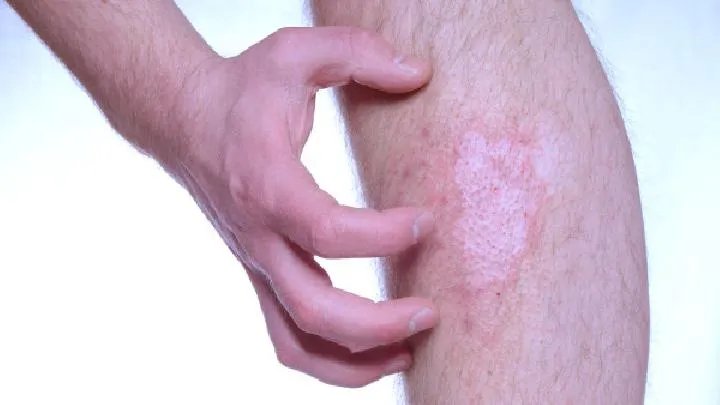 牛皮癣传染吗怎么治愈
