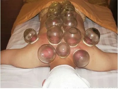 女子拔罐背部起火是怎么回事？