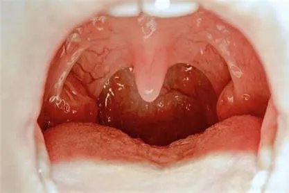 宝宝幼儿急疹初期图片