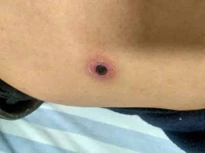 恙虫病焦痂图片