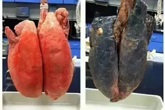 戒烟一年的肺真实图片