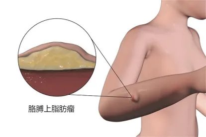 胳膊上脂肪瘤图片