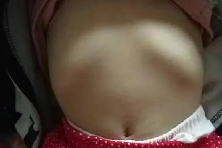 小孩子肋骨外翻图片