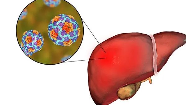 急性肝炎是怎么回事