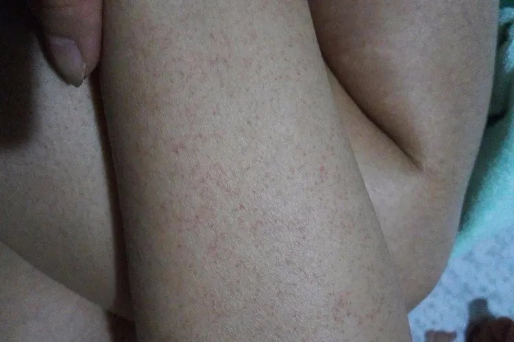 白血病初期针孔小红点图片