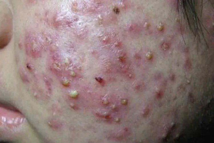 粉刺图片