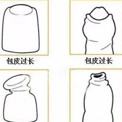 长沙包皮过长会有什么症状