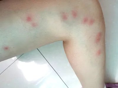 湿疹大腿症状图片