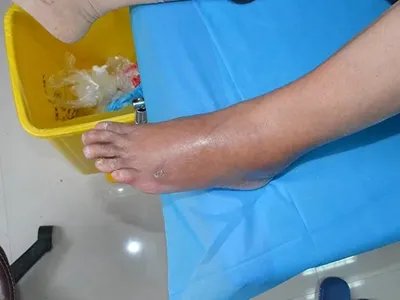 急性网状淋巴管炎脚背症状图片