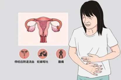 什么是葡萄胎图片，早期症状图片