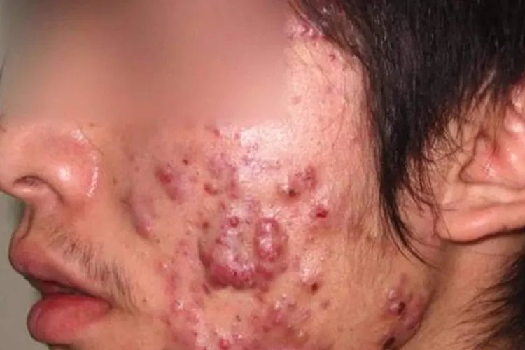 痤疮是什么图片