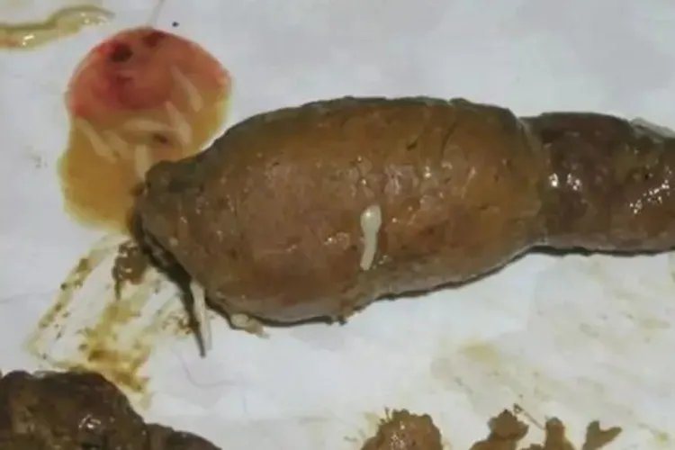 大便中的绦虫节片图片