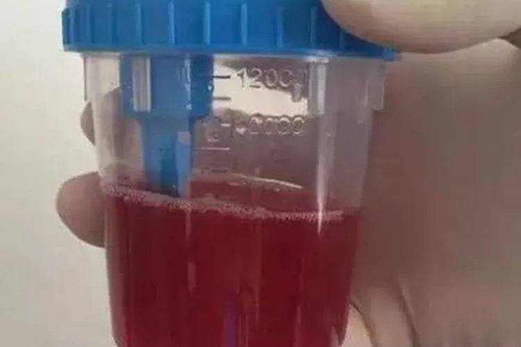 红斑狼疮是什么症状图