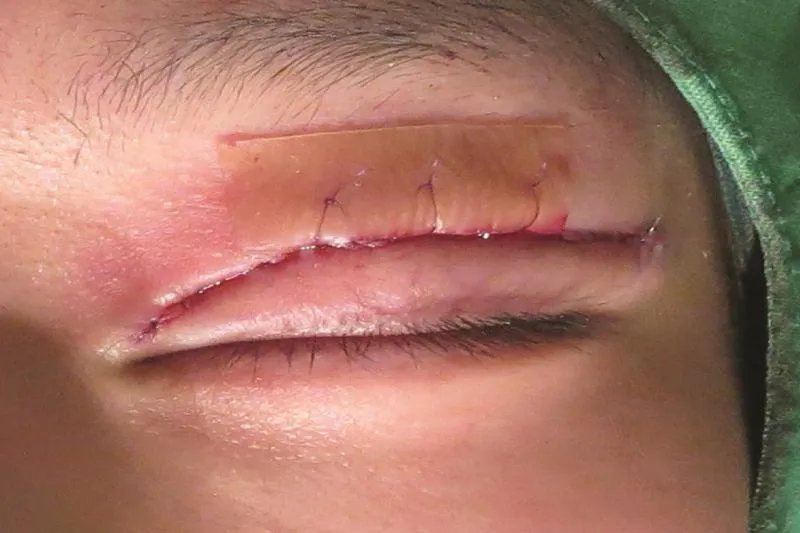 做完双眼皮的样子图片