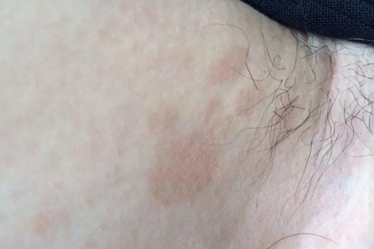 大腿汗斑癣图片大全