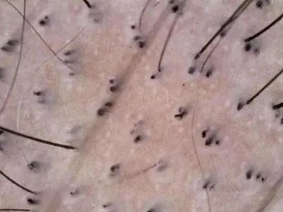 拔毛癖头皮症状图片