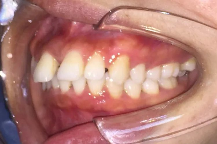 门牙补牙过程图解