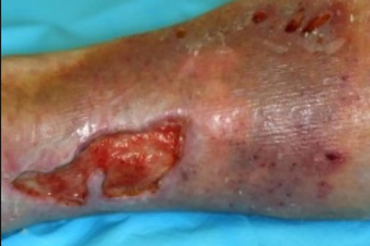 常见皮肤病图谱