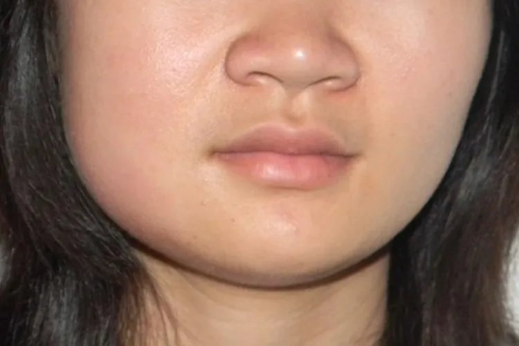 腮腺淋巴结肿大图片