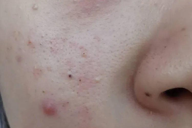 脸上长痘痘位置图解