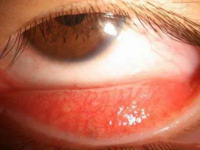 红眼病症状图片